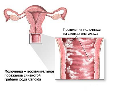 Лечение Молочницы У Женщин Флюкостатом